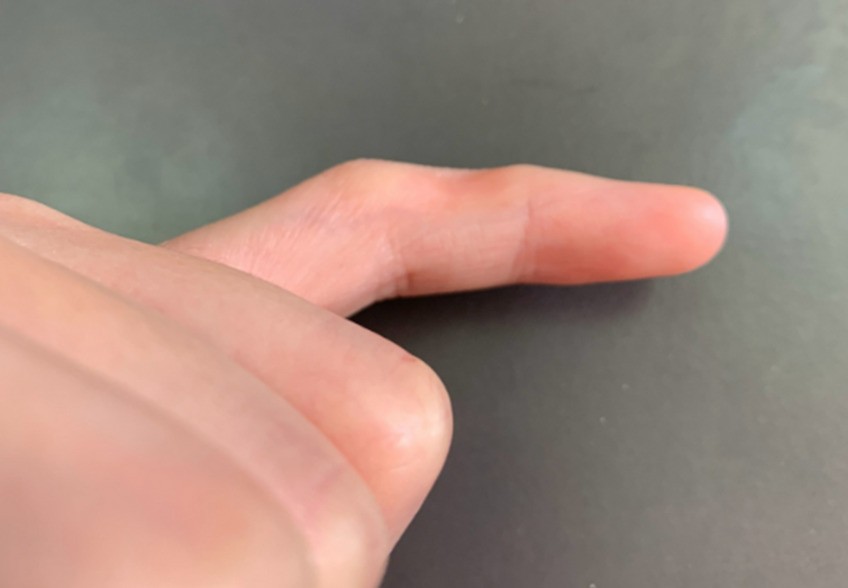 小拇指凹坑,就是新时代的“手机病”